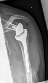 Inverse Schulter TEP_ap.jpg Inverse Schulter TEP_ap.jpg